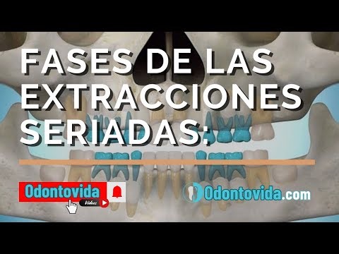 Fases de las Extracciones Seriadas: Protocolo y Manejo Clínico