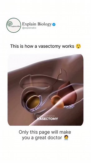 BIOLOGY | MEDICAL | LIFE on Instagram: "A vasectomy is a surgical procedure for men that works as a permanent birth control method. 🩺 It involves cutting or blocking the vas deferens — the tubes that carry sperm from the testicles. After the procedure, sperm can’t leave the testicles, preventing fertilization. Follow us @explainabio for more 🔥 . . . . . . . . . . . . #health #medicine #biomedicine #vasectomy #birthcontrol #medicalfacts #menhealth #foryou #healthawareness #doctor #humanbodyfact