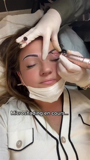 Microshading Procedure: What to Expect and Benefits