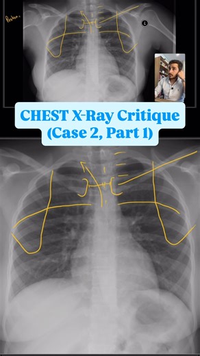 Dr. Sahand Hooshmand on Instagram: "Positioning critique for this Chest X-Ray. This is the 1st part of Case 2 in this Chest critique series! #radiography #medicalimaging #xray #chest #cxr"