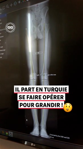 « 9.5 centimètres, ce n'est pas possible ? » Complexé par sa taille, Félix a payé 30 000 euros afin de partir en Turquie se faire opérer des jambes et grandir de presque 10 centimètres... « Prêts à tout pour grandir » 📺 #66minutes, dimanche à partir de 17:20 sur M6 | M6 Mag