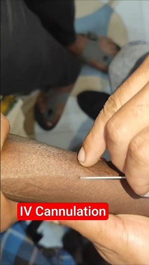 IV Cannulation Technique Procedure