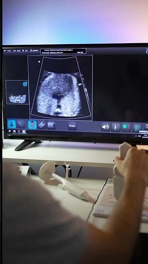 Volutracer OPUS Ultrasound Simulator - Transverse plane of a Fetal Abdomen