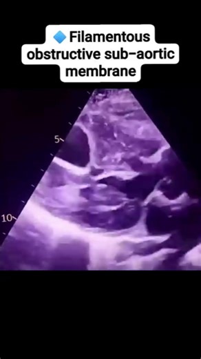 new Educational Echo Case Check the first comment #cardiology
