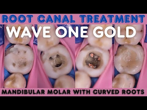 Root Canal Treatment 🔵 Mandibular Molar with Extremely Curved Roots ⚪️ Wave One Gold