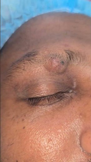 Eyebrows cyst