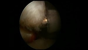 Arthroscopic Double Row Subscapularis Repair
