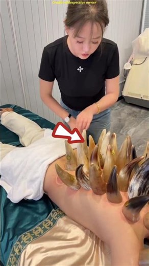 Cupping Therapy: Ancient Chinese Pain Relief Technique #shots #facts