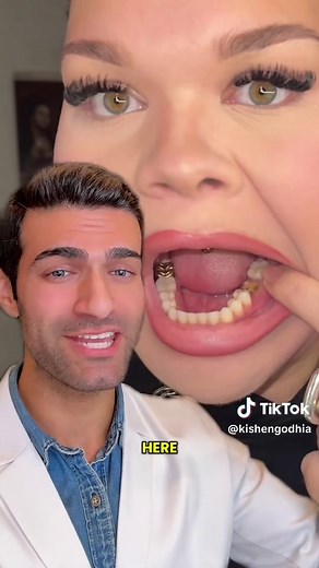 What to Do When Your Dental Crown Comes Off