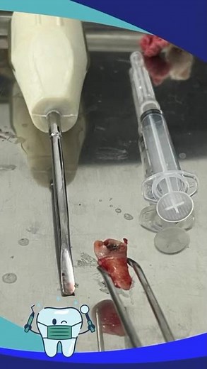 Wisdom Tooth Extraction | Safe & Painless Dental Care in Lucknow | Apex Dentals