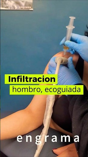 Infiltración de hombro ecoguiada #prp #colageno