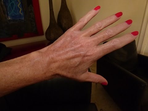Hand Vein Treatment