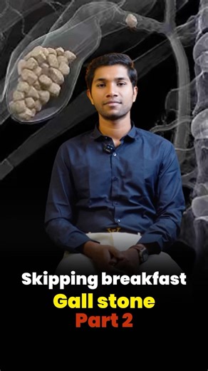 Skipping breakfast | Gall stone | Dt Siva Prasath