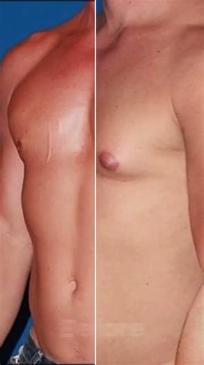 Why Chest Training Won’t Fix Bodybuilder Gynecomastia