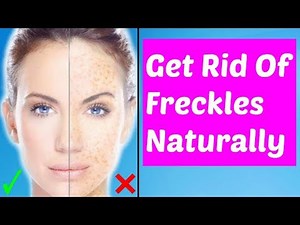 How To Get Freckles Naturally Overnight | Can You Have Freckles Removed