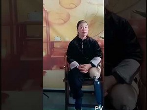 SAK AMputee and prosthetic leg. Big stump