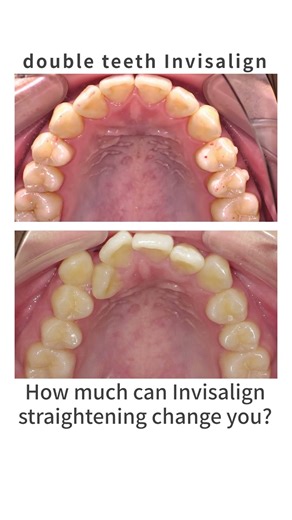 Straighten double teeth with Invisalign #AI #orthodontist #32nd