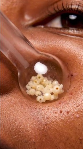 Blackhead Plug Pull — Ultra Close
