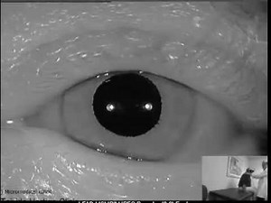 Canalalith Repositioning Procedure for Left Posterior Canal BPPV