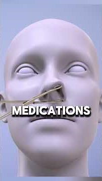 Nasal polyps removal process