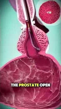 Enlarged Prostate Surgery Explained! #facts #knowledge #interestingfacts #interesting #shorts