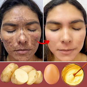 4.3M views · 31K reactions | My mother is 60 years old - We wipe her spots with potato mask - Face lifting and stop sagging #skincare #beauty | Simple Home Remedies | Facebook
