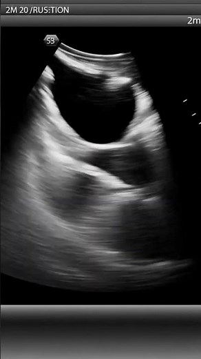 Ultrasound Scan Shows Twin Pregnancy 🤰 #pregnancy #viralshorts