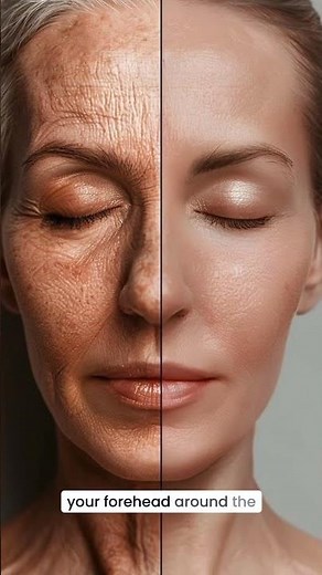 Botox Explained by a Plastic Surgeon | Part 1: What is Botox? #plasticsurgery #botox
