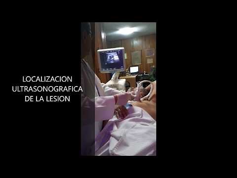 BIOPSIA DE MAMA GUIADA POR ULTRASONIDO