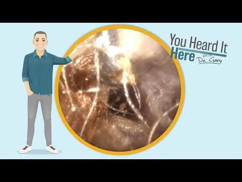 Tangled Wax and Ear Hair - The "Bird's Nest" Extraction | Earwax Removal VLOG #121