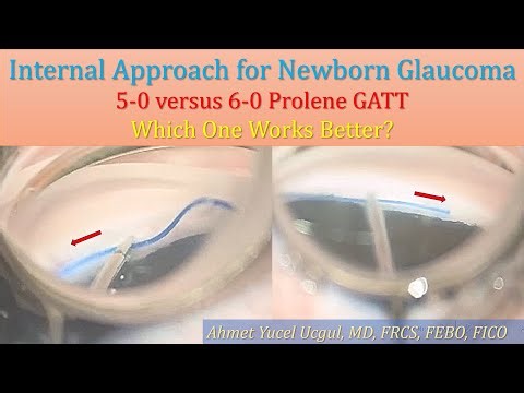 Internal Approach for Primary Congenital Glaucoma: 5-0 versus 6-0 GATT - Which one works better?