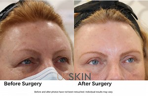 Eyelid Surgery London | UK | UKSKIN