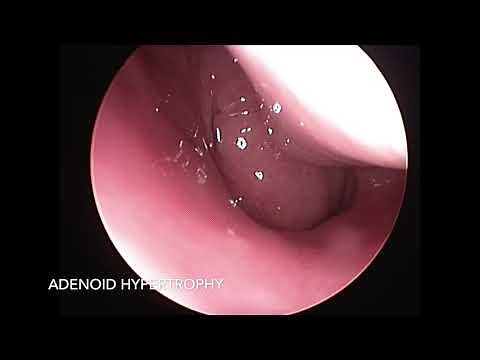 Adenoid Hypertrophy - Diagnostic Nasal Endoscopy