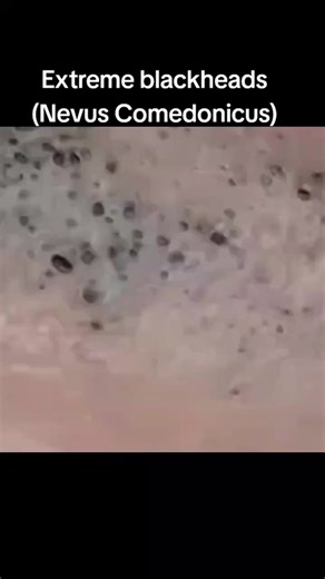 Extreme Blackheads Extraction: Nevus Comedonicus Treatment