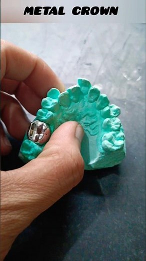 Metal Crown Dental Treatment | Types, Benefits, Procedure