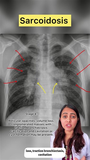 🫁 Bilateral Hilar Lymphadenopathy (BHL) BHL refers to symmetrical enlargement of lymph nodes at both lung hila, commonly seen on chest X-ray or CT scan. It reflects underlying granulomatous, infectious, malignant, or inflammatory disease. 🔹 Common Causes 🌿 Sarcoidosis (most common) • Classically presents with symmetrical BHL • Often young or middle-aged adults • May be associated with: – Erythema nodosum – Uveitis – Dry cough, dyspnoea • Non-caseating granulomas on biopsy 🦠 Infections • Tube