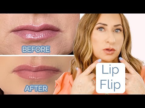 LIP FLIP- Can you Tell?!? BEFORE and AFTER {Botox Over 40}