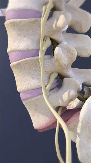 What is Spondyloptosis?