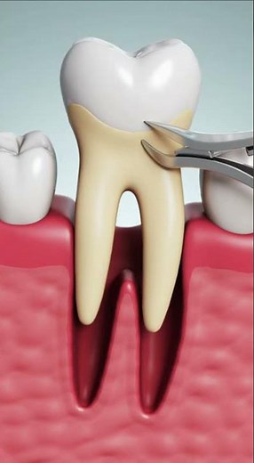 Need a tooth extraction? Here’s what actually happens.