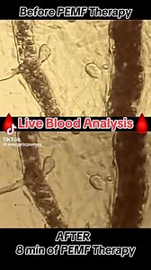 Much like a battery, the human body is electric. In order for a cell to stay healthy, it needs voltage and nutrients. PEMF charges the cell! In addition, PEMF therapy increases blood circulation and oxygen supply (where oxygen flows, healing goes). When our bodies have low voltage, the cells lack oxygen and clump together. When the cells are charged, they repel one another and allow the increase in circulation and oxygen transport (as seen in this before and after video). This allows the body’s 