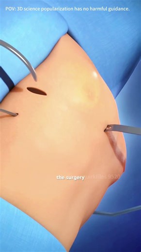 Pectus Excavatum Surgery Animation