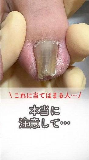 爪トラブルの特徴 #巻き爪ケア #巻き爪 #巻き爪矯正 #巻き爪治療 #巻き爪改善