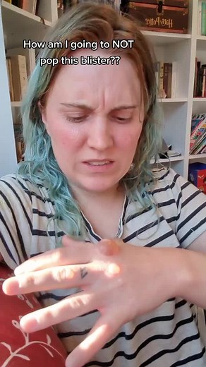 if there's one thing I'm good at, it's avoiding touching things with my hands 🙃 Also the blisters are from burning off warts 🤢#ocd #contaminationocd #blisterpop