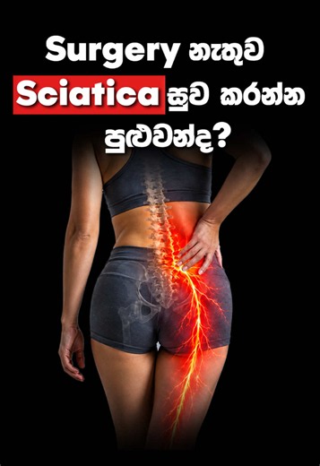 Surgery නැතුව Sciatica සුව කරන්න පුළුවන් ද ? කොන්දෙන් පටන්ගෙන කකුල දිගේ පහළට යන වේදනාවක්, හිරිවැටීමක් ඔබටත් දැනෙනවාද? මෙවැනි ලක්ෂණ Sciatica සමඟ සම්බන්ධ විය හැකියි. නිවැරදි හේතුව හඳුනාගෙන, ඔබට ගැළපෙන ප්‍රතිකාර ක්‍රමය තීරණය කිරීම වැදගත්. මෙවැනි වේදනාවන් දිගින් දිගටම පවතිනවා නම් නොසලකා හරින්න එපා. ඔබේ සෞඛ්‍යය පිළිබඳ නිවැරදි උපදෙස් ලබාගැනීම සඳහා සුදුසුකම් ලත් වෛද්‍යවරයෙකු හමුවන්න. #ceylonhospital #sciaticarelief #sciatica #pain #backpain