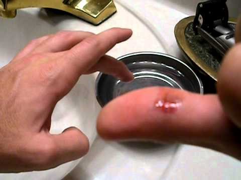 Superglue a wound