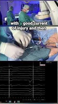 Stepwise CSP Lead Placement in Action