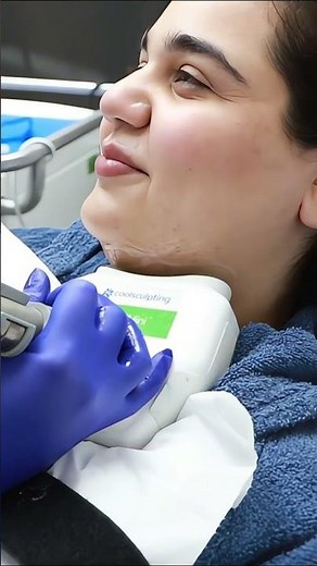 Bye Double Chin! Real CoolSculpting Results #Shorts