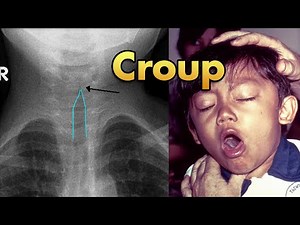 Croup (Laryngotracheobronchitis) Explained: Pathophysiology, Signs & Symptoms, Diagnosis & Treatment