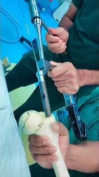 #PFNSurgery #HipFracture #OrthopedicVideo #TraumaSurgery#Orthopedics #MedicalEducation #OrthoImplane