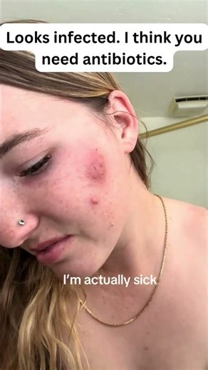 Looks infected I think you need antibiotics